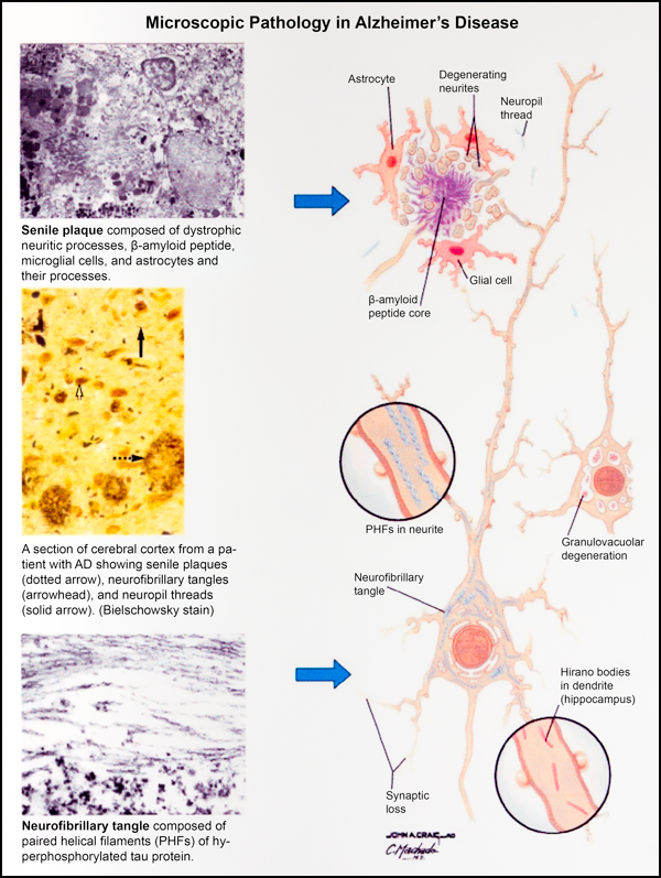 Microscopic Pathology of Alzheimer's Disease