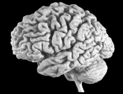 Human Brain with Alzheimer's Disease