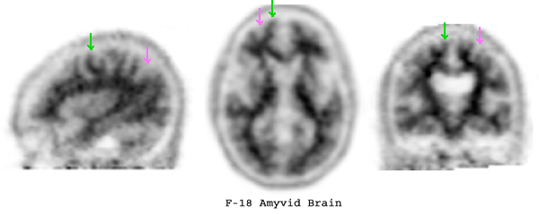 Amyvid PET scan negative study