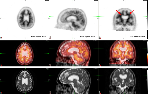 Fusion Amyvid PET-MRI