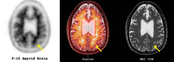 Fusion Amyvid PET - MRI