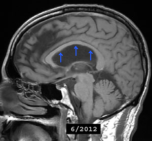 Sagittal brain MRI