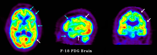 FDG PET Brain scan