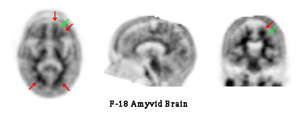 Amyvid Brain PET scan