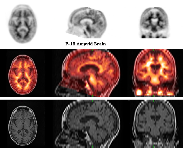 Amyvid - MRI fusion