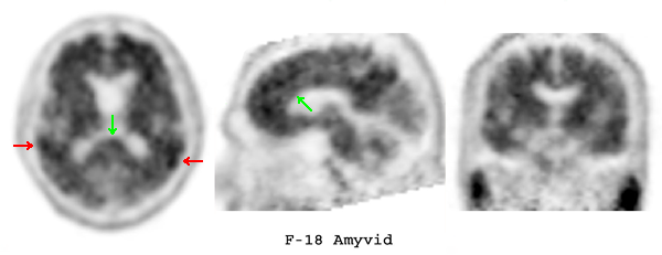 Amyvid PET Brain scan