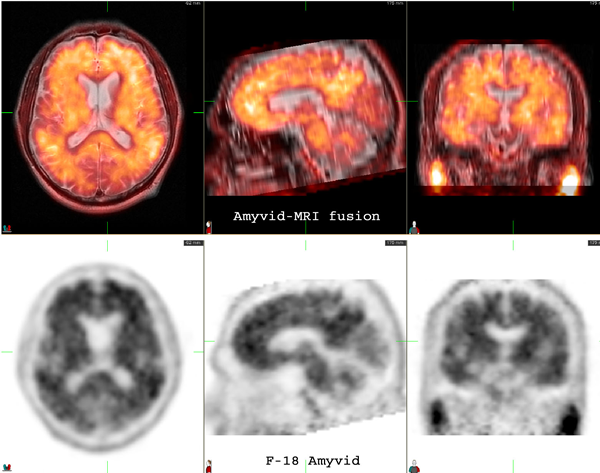 Amyvid - MRI fusion Brain scan